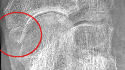 Accessory Navicular