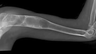 Bone Cysts and Tumors