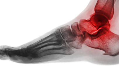 Tarsal Koalisyon