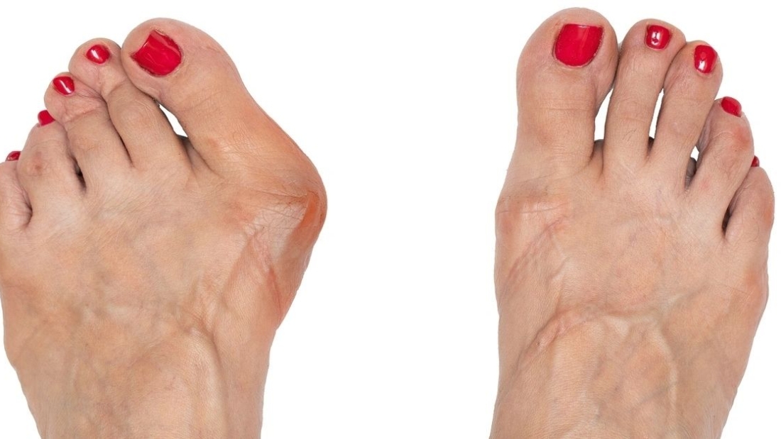 مرض إبهام القدم الأروح