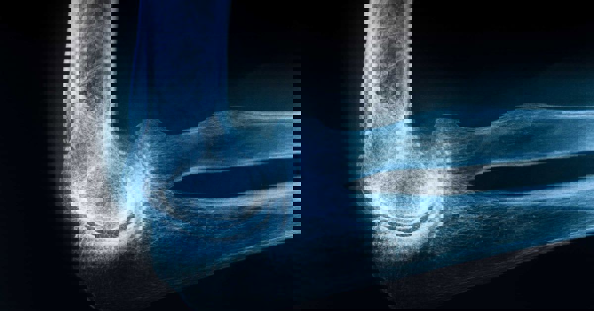 Elbow Dislocation Elbow Dislocation