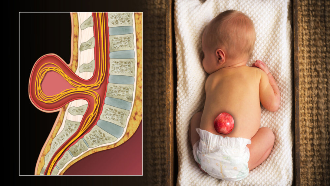 جراحة السنسنة المشقوقة