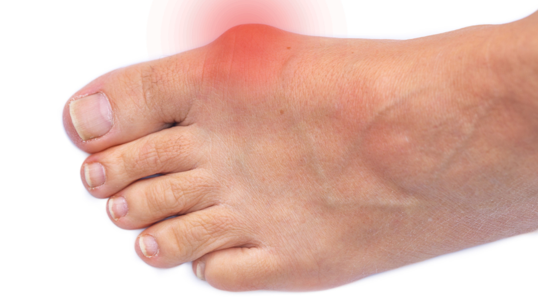 Болезнь молоткообразных пальцев