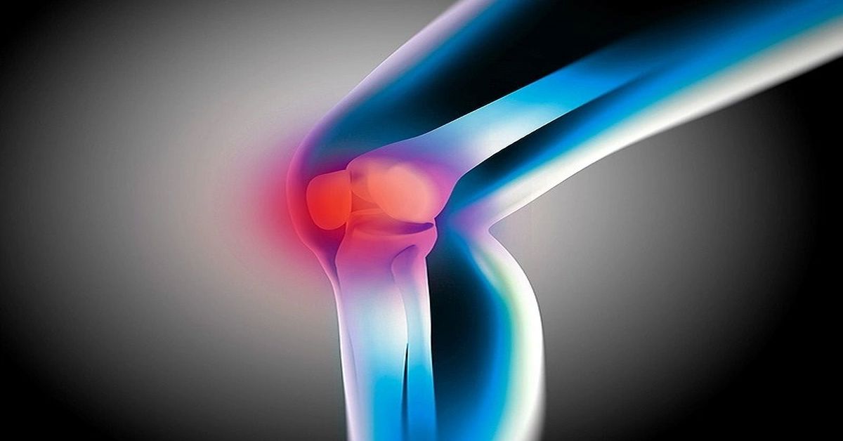 What is Kneecap Dislocation? What is Kneecap Dislocation?