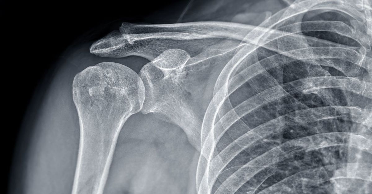 Что такое перелом плеча? Что такое перелом плеча?