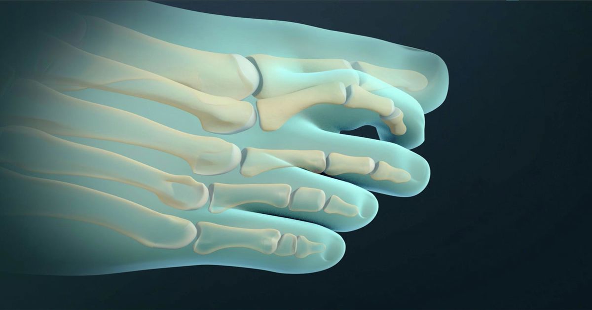 Hammer Finger Treatment Hammer Finger Treatment