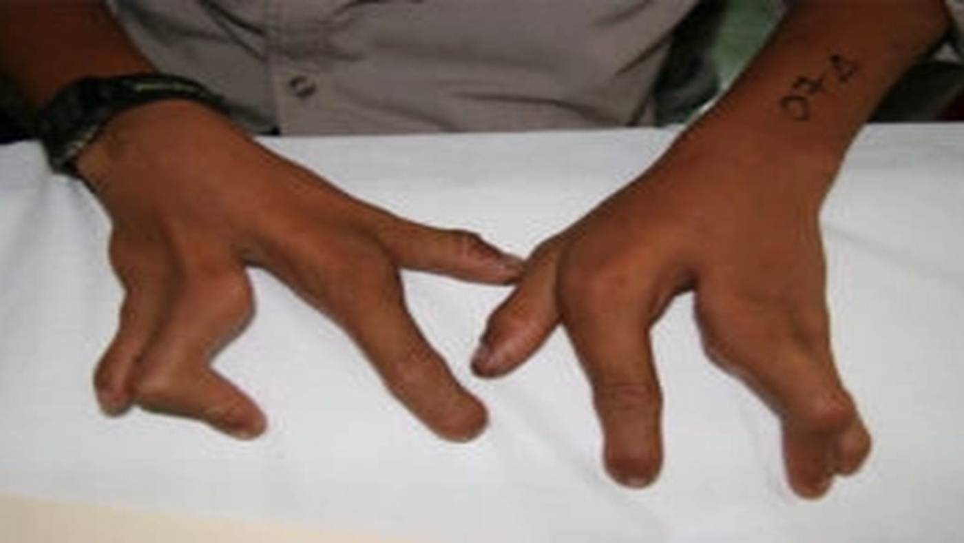 Makrodaktili Ameliyatı