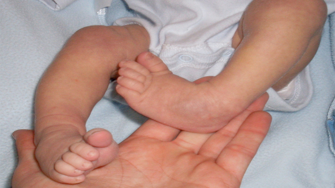 Artrogriposis Nedir?