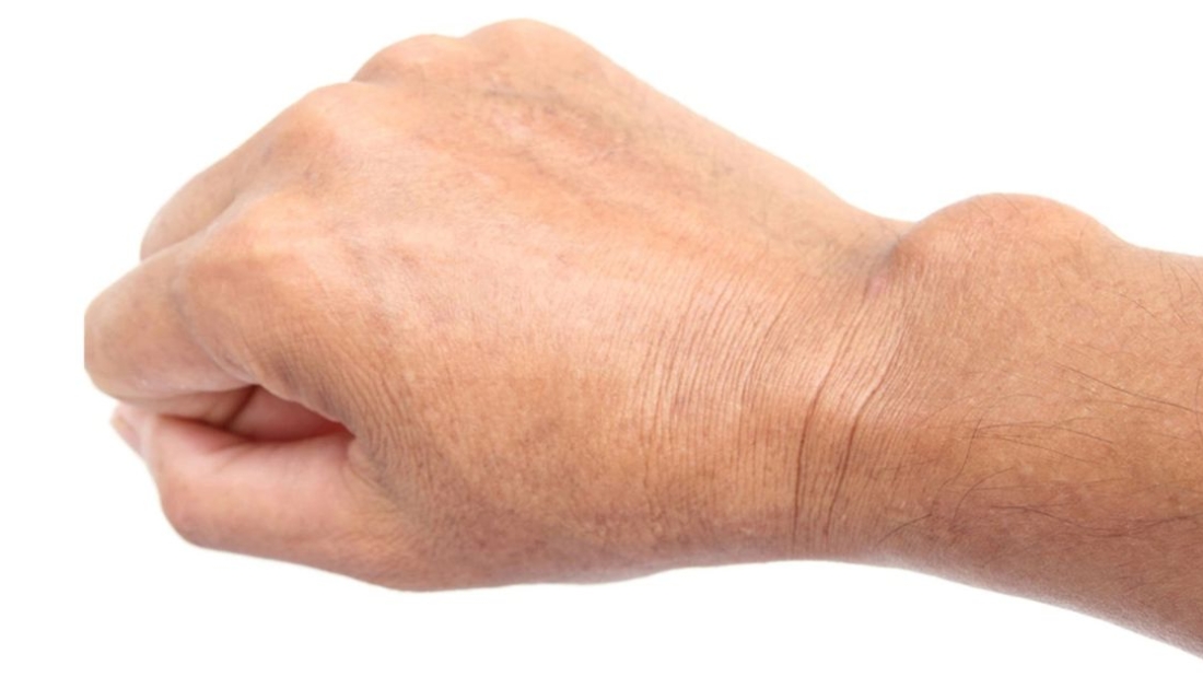 Kemik Kisti Ameliyatı