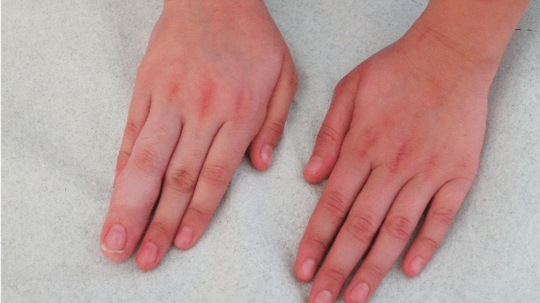 Makrodaktili Hastalığı Tedavisi