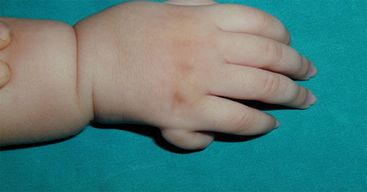 Polidaktili Ameliyatı Polidaktili Ameliyatı