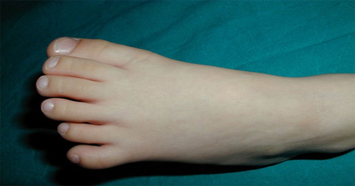 Polidaktili Ameliyatı Polidaktili Ameliyatı