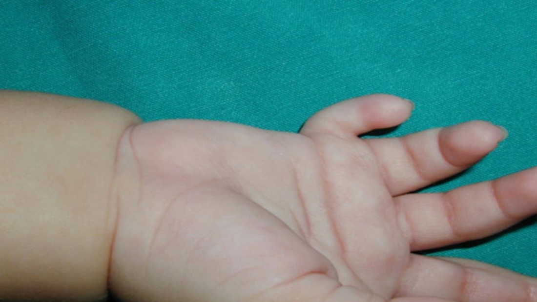 Polidaktili Ameliyatı