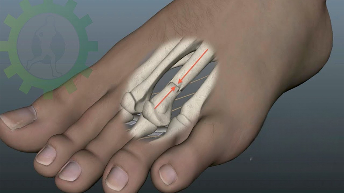 Stres Kırığı Tedavisi