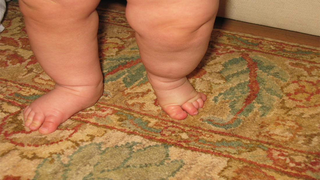 Tibial Hemimelia Nedir?