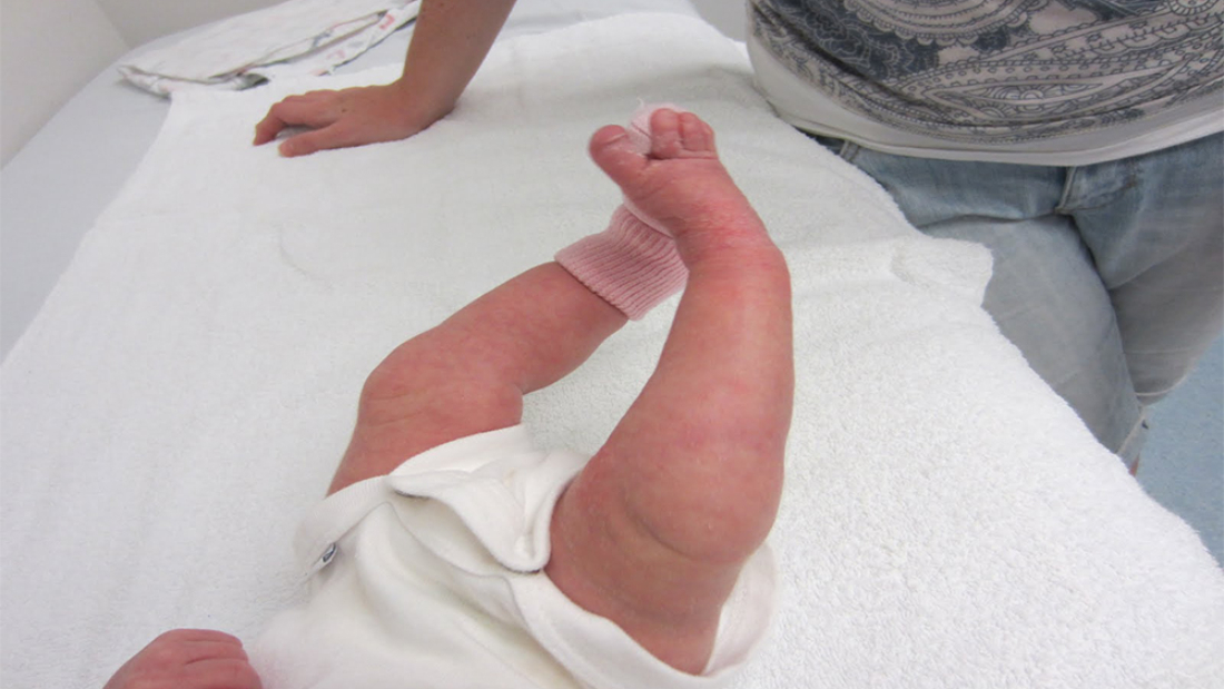 Fibular Hemimelia Nedir?