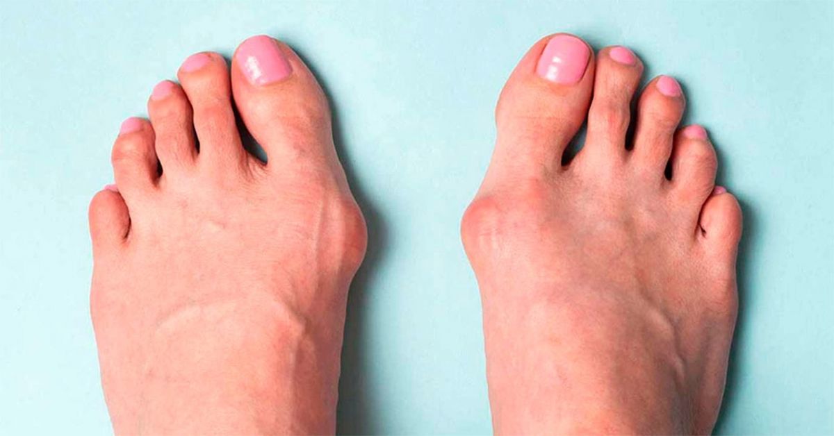 Halluks Valgus Ameliyatı Halluks Valgus Ameliyatı