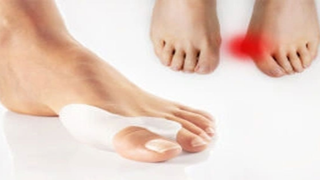 Halluks Valgus Ameliyatı