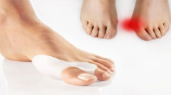 Halluks Valgus Ameliyatı