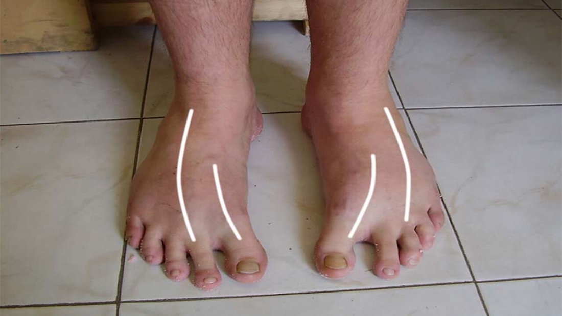 Metatarsus Adduktus Nedir?