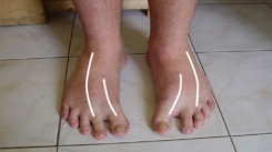 Metatarsus Adduktus Nedir?