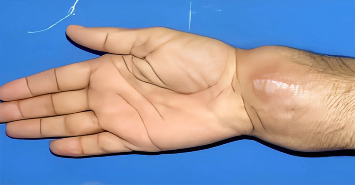 Ollier Hastalığı Tedavisi Ollier Hastalığı Tedavisi