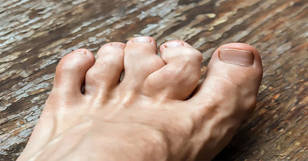 Ollier Hastalığı Tedavisi Ollier Hastalığı Tedavisi