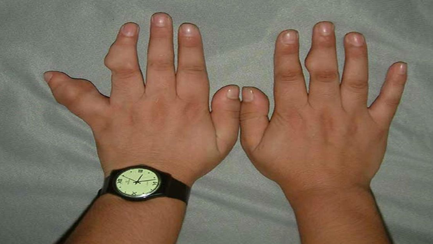 Ollier Hastalığı Tedavisi