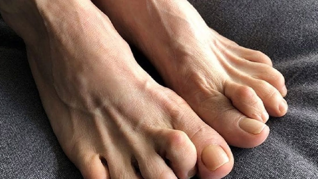 pençe-parmak-tedavisi-3