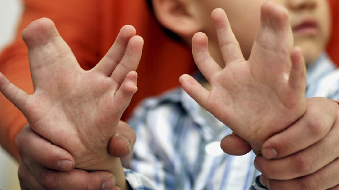 Sindaktili Ameliyatı