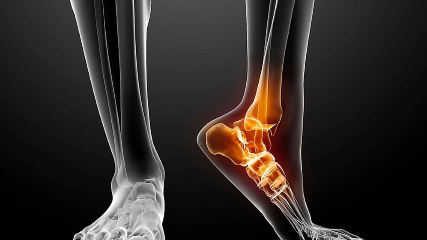 Stres Kırığı Ameliyatı