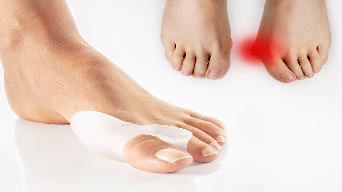 Halluks Valgus Nedir?