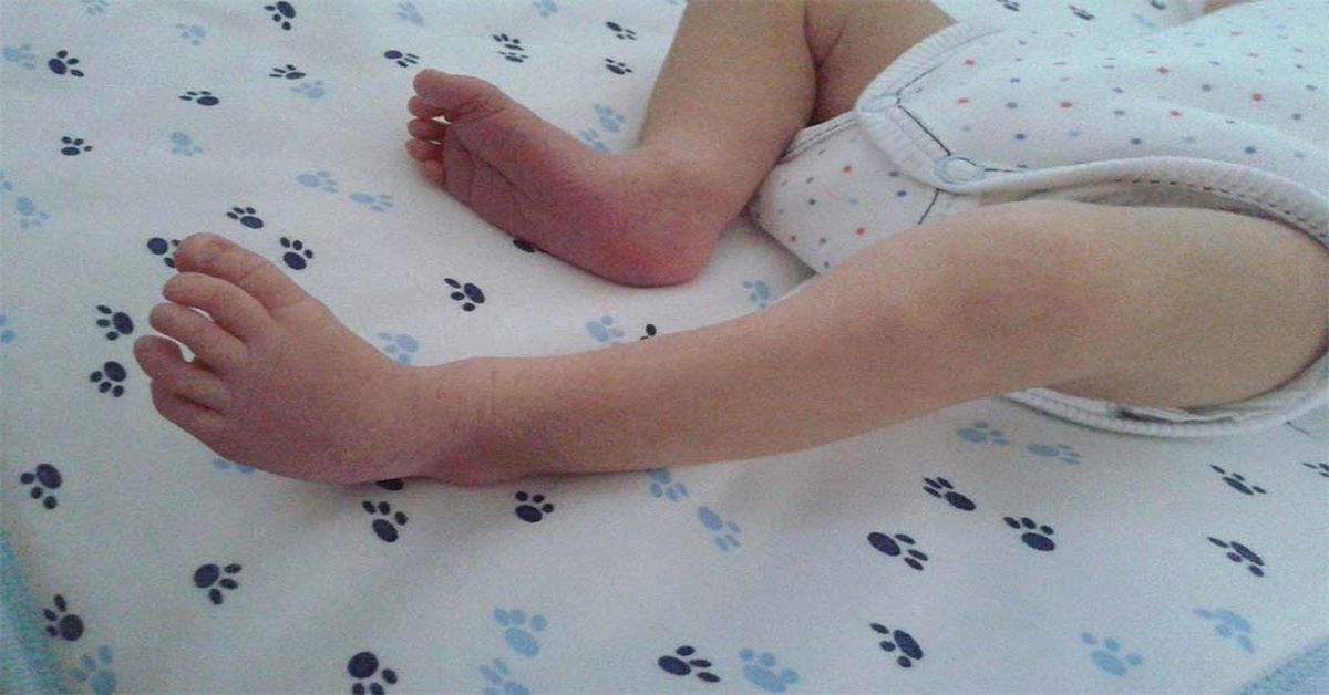 Metatarsus Adduktus Tedavisi Metatarsus Adduktus Tedavisi