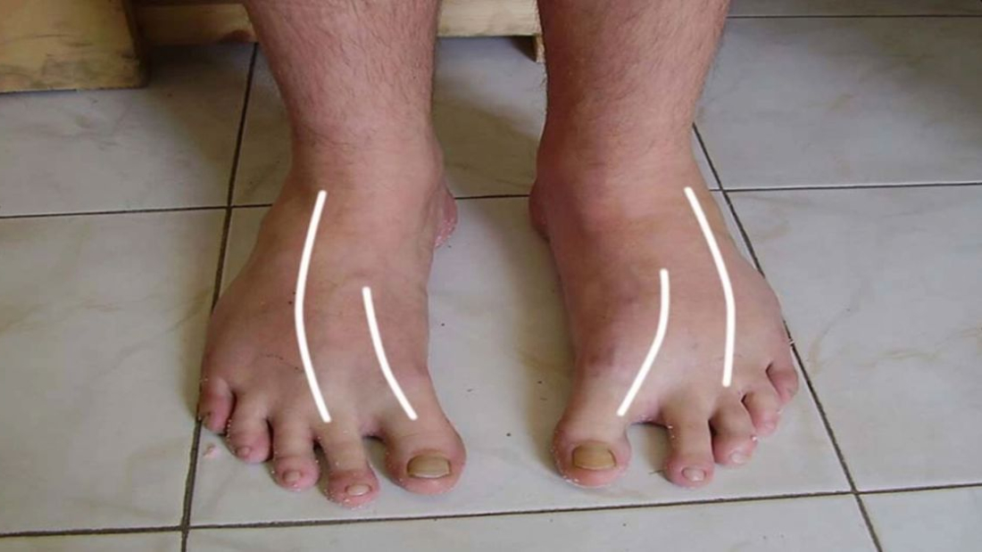 metatarsus-adduktus-tedavisi-3