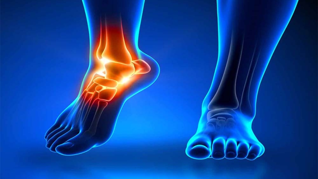 Tarsal Koalisyon Ameliyatı