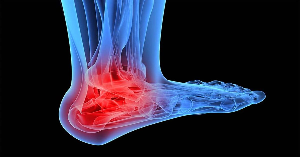 Tarsal Koalisyon Ameliyatı Tarsal Koalisyon Ameliyatı