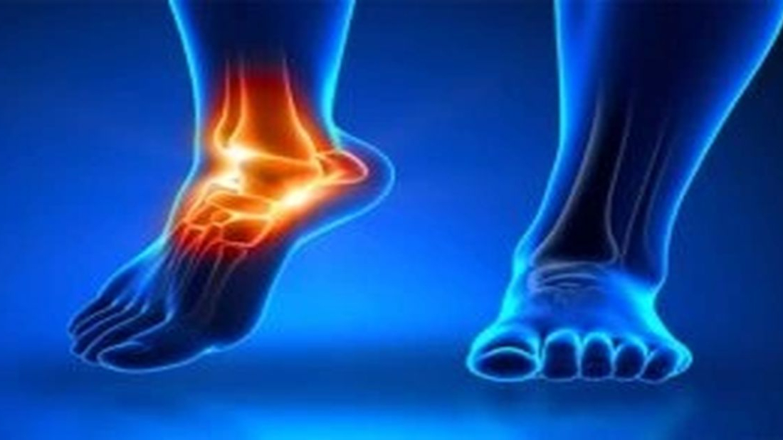 Tarsal Koalisyon Ameliyatı