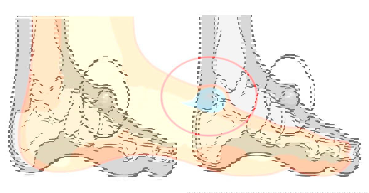 Kemik Kisti Tedavisi Kemik Kisti Tedavisi