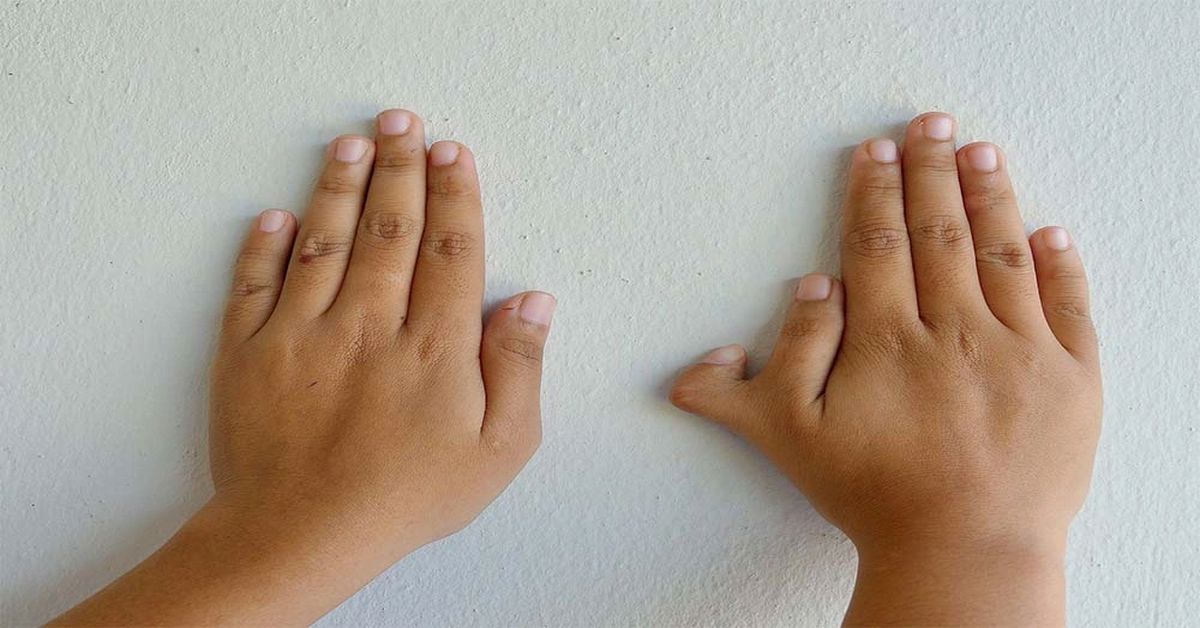 Polidaktili Nedir? Polidaktili Nedir?