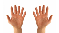 Polidaktili Nedir?