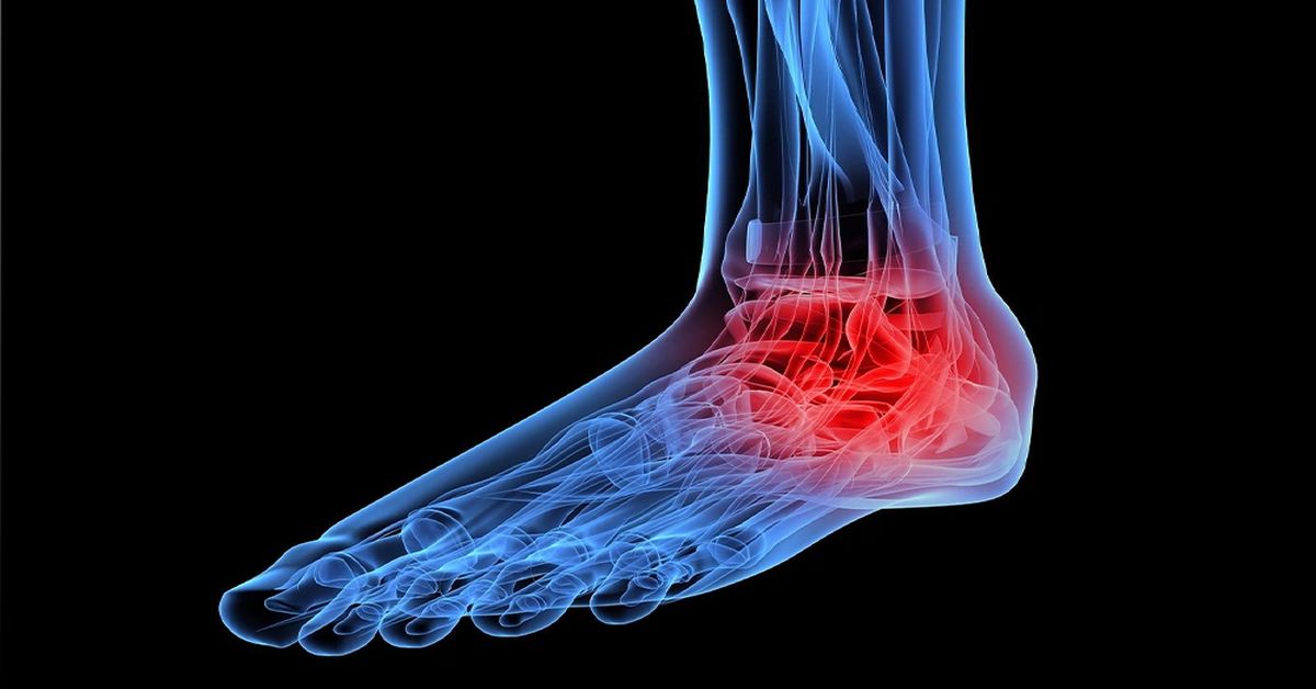 Tarsal Koalisyon Nedir? Tarsal Koalisyon Nedir?