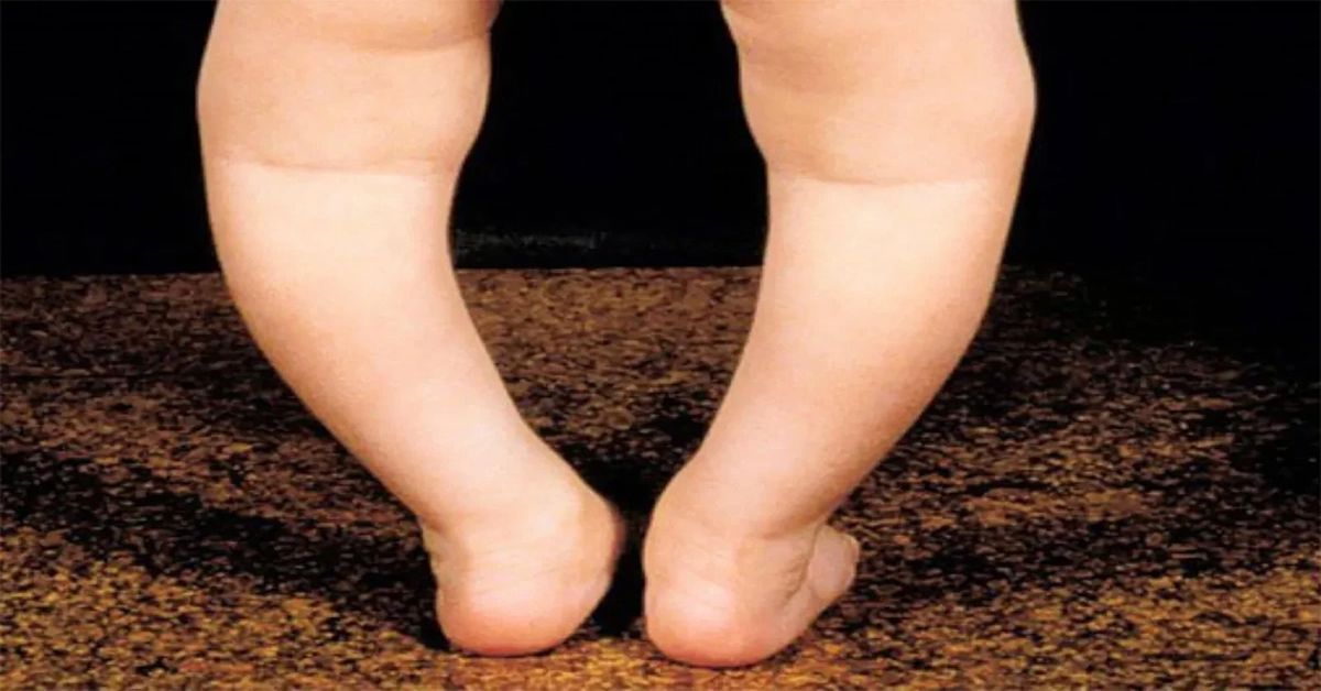 Blount's Disease Blount's Disease