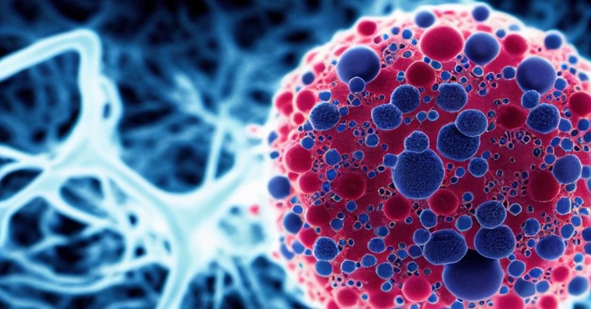 Yumuşak Doku Tümörü Yumuşak Doku Tümörü