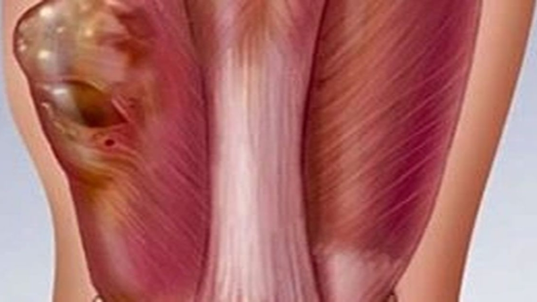 Yumuşak Doku Tümörü