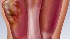 Yumuşak Doku Tümörü