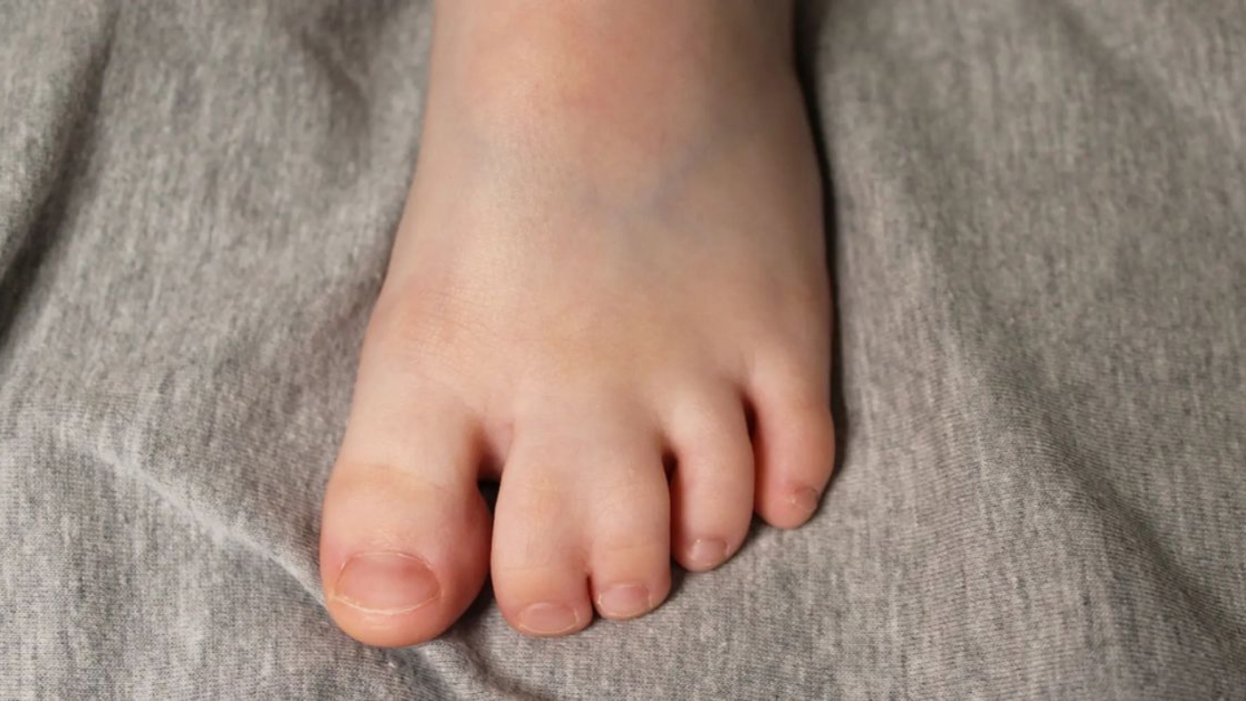 علاج ارتفاق الأصابع