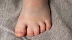 sindaktili-tedavisi-3