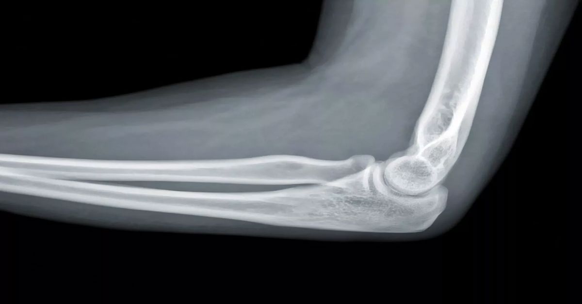 dirsek çıkığı tedavisi dirsek çıkığı tedavisi